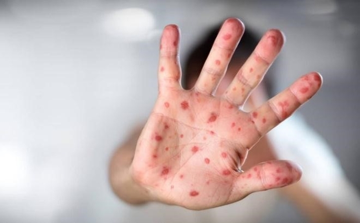 TP.HCM: Cảnh b&aacute;o bệnh tay &ndash; ch&acirc;n &ndash; miệng v&agrave;o m&ugrave;a