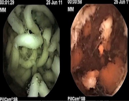 Sau 2h v&agrave;o cơ thể mỳ ăn liền vẫn chưa được ph&acirc;n hủy 