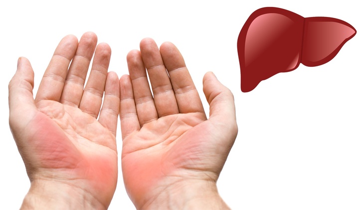 L&ograve;ng b&agrave;n tay bỗng dưng xuất hiện m&agrave;u đỏ rất c&oacute; thể bạn đang c&oacute; vấn đề về gan