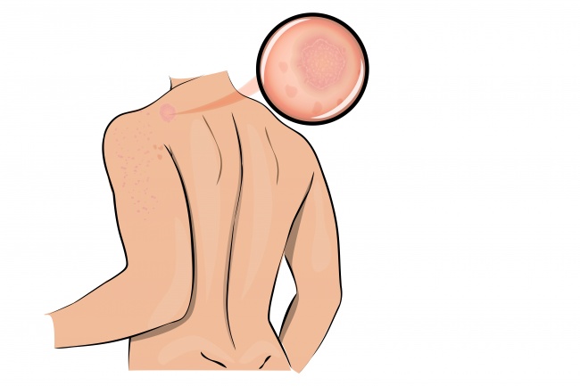Bệnh về da xuất hiện chứng tỏ bạn đang bị căng thẳng 