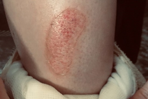 B&eacute; g&aacute;i bị bỏng độ 3 v&igrave; keo d&aacute;n m&oacute;ng tay giả