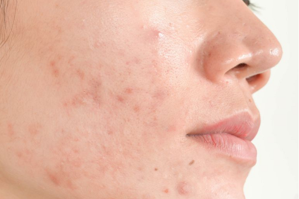 Da bị mụn - Những t&aacute;c nh&acirc;n kh&ocirc;ng ngờ