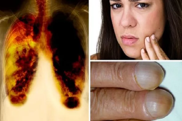 Ung thư phổi - Những triệu chứng c&oacute; thể ph&aacute;t hiện qua m&oacute;ng tay