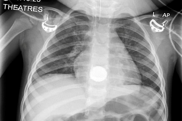 B&eacute; g&aacute;i 2 tuổi su&yacute;t tử vong v&igrave; nuốt phải pin c&uacute;c