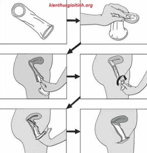 C&aacute;ch sử dụng bao cao su nữ