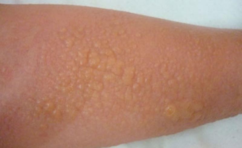 C&aacute;nh tay bị phổng rộp sau khi lột da tắm trắng