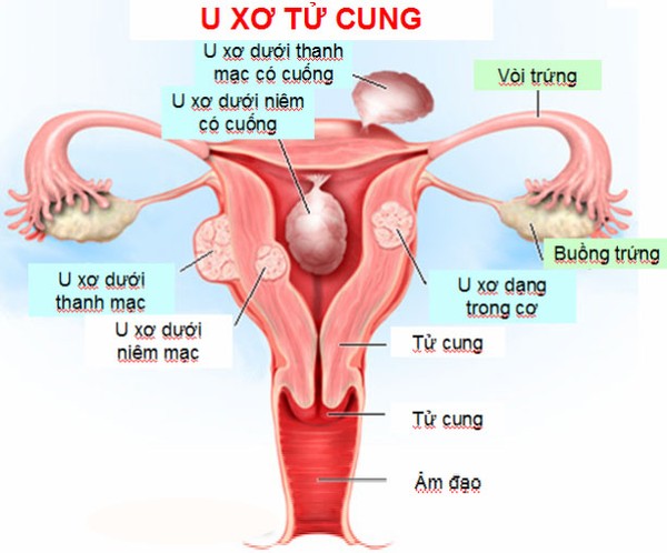 Bệnh u xơ ổ tử cung ph&aacute;t triển khi trời lạnh