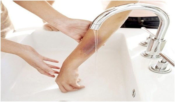 Ung thư m&aacute;u c&oacute; thể từ những vết thương nhỏ hằng ng&agrave;y