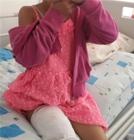 Vết bỏng của Ariana s&acirc;u đến tận xương