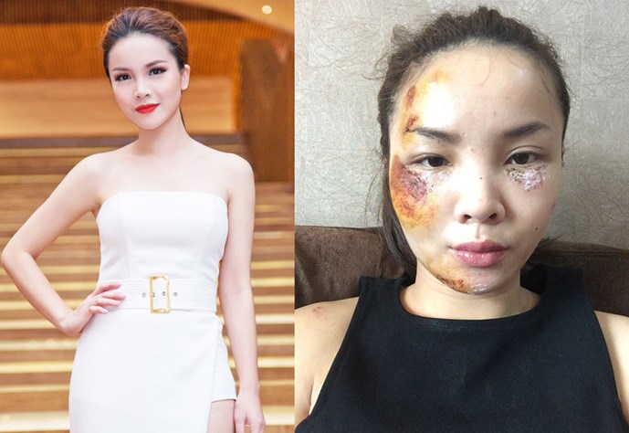 Gương mặt trầy n&aacute;t của Yến Trang sau vụ tai nạn giao th&ocirc;ng nghi&ecirc;m trọng khiến người h&acirc;m mộ x&oacute;t xa
