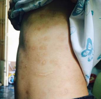 Những dấu vết nghi bị bạo h&agrave;nh gia đ&igrave;nh của em T