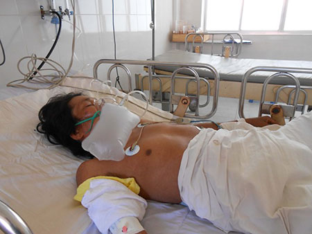 Anh Điểu Ba vẫn đang thở bằng m&aacute;y.