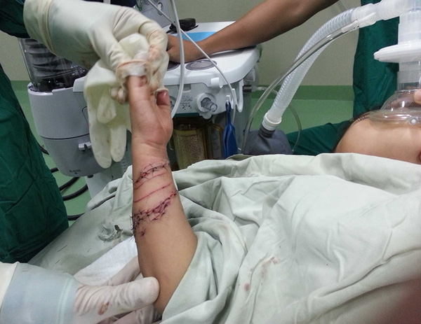Vết thương do bị c&aacute; sấu cắn đ&atilde; được c&aacute;c b&aacute;c sĩ kh&acirc;u lại sau ca phẫu thuật