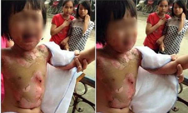 Do cô giáo mầm non không chú ý, bé gái 3 tuổi bị bạn đốt bỏng khắp người do Do cô giáo mầm non không chú ý, bé gái 3 tuổi bị bạn đốt bỏng khắp người do