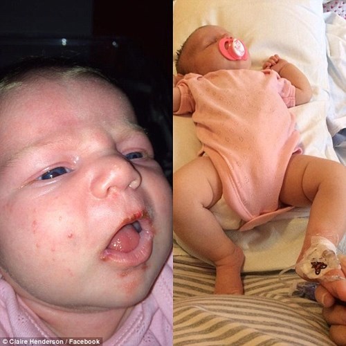 B&eacute; sơ sinh phải nằm ở bệnh viện điều trị do bị lở miệng qu&aacute; nặng v&igrave; nhiễm vius Herpes