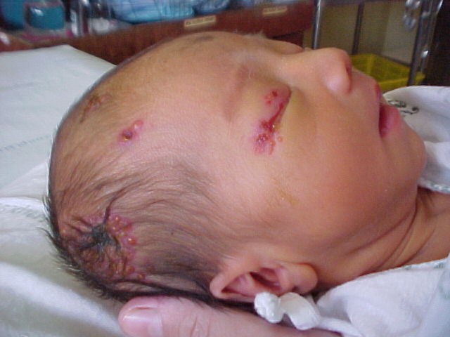 B&agrave; mẹ người Anh Claire Henderson cảnh b&aacute;o kh&ocirc;ng n&ecirc;n h&ocirc;n b&eacute; sơ sinh để tr&aacute;nh trẻ bị nhiễm virus Herpes