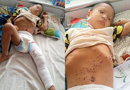 B&eacute; trai 8 tuổi Đặng T&ograve;n Nhảy bị thương nặng su&yacute;t chơi v&igrave; chơi k&iacute;p nổ do cha nhặt về