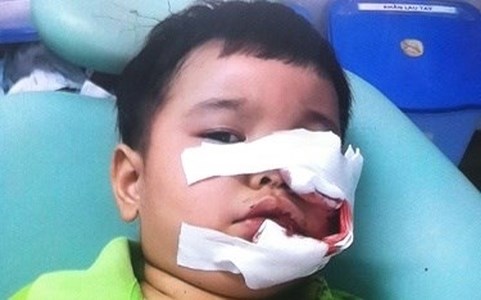 B&eacute; trai chơi đ&ugrave;a với ch&oacute; bị ch&oacute; cắn r&aacute;ch nhiều vết thương
