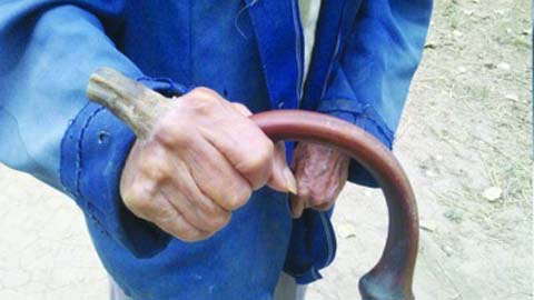 Theo c&aacute;c chuy&ecirc;n gia, căn bệnh lạ người phụ nữ đang mắc phải l&agrave; bệnh sừng da
