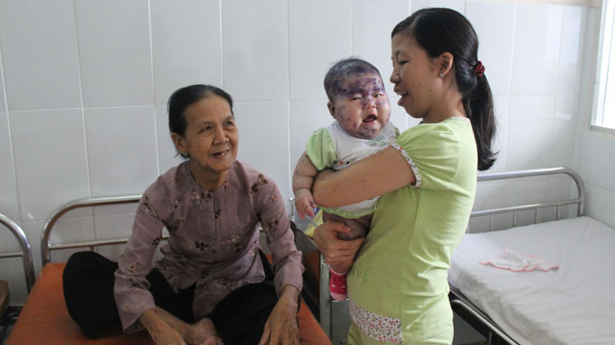 Bệnh thủy đậu đang c&oacute; nguy cơ b&ugrave;ng ph&aacute;t trong đợt giao m&ugrave;a