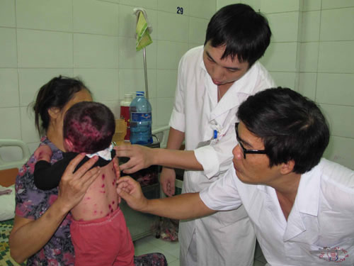 Bệnh thủy đậu đang c&oacute; nguy cơ b&ugrave;ng ph&aacute;t v&agrave;o dịp giao m&ugrave;a