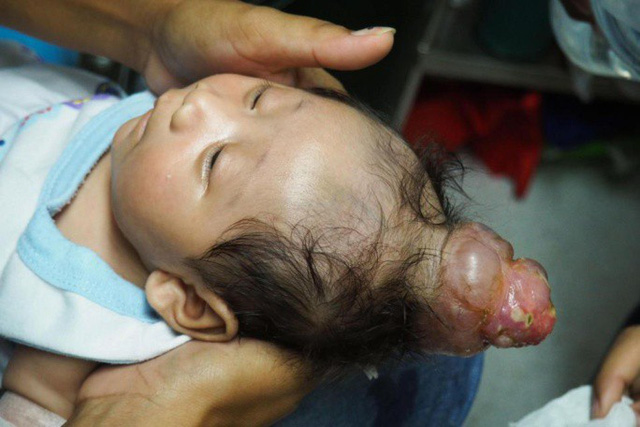 ky-la-be-so-sinh-moc-sung-ky-lan-he-lo-nguyen-nhan-kinh-hai
