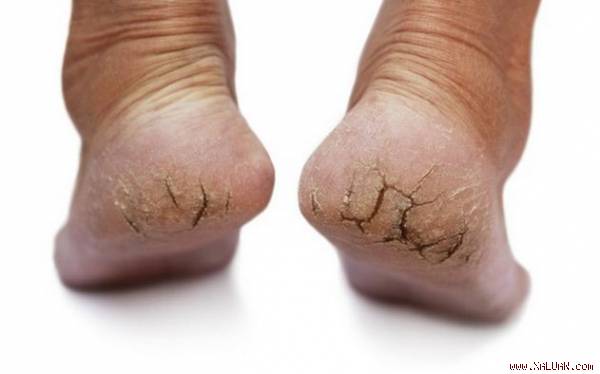 c&aacute;ch trị nứt g&oacute;t ch&acirc;n