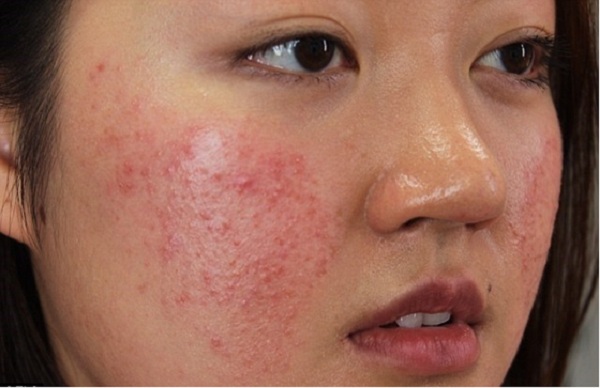 chất corticoid trong c&aacute;c c&ocirc;ng thức l&agrave;m trắng da g&acirc;y mưng mủ, ngứa ng&aacute;y da mặt