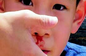 ph&ograve;ng ngừa chảy m&aacute;u cam ở trẻ l&agrave; một phương ph&aacute;p gi&uacute;p trẻ c&oacute; sức khoẻ tốt