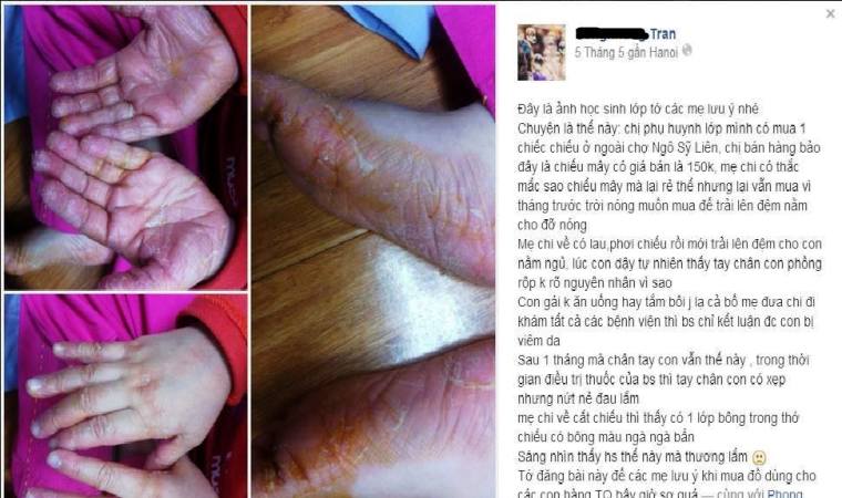 H&igrave;nh ảnh Chiếu điều h&ograve;a Trung Quốc gi&aacute; rẻ g&acirc;y vi&ecirc;m da, dị ứng da được chia sẻ tr&ecirc;n Facebook