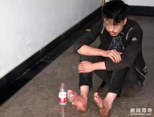 Đôi chân của Chen bị phồng rộp vì nắng nóng và đang dần thối rữa. Ảnh: People Daily Đôi chân của Chen bị phồng rộp vì nắng nóng và đang dần thối rữa. Ảnh: People Daily
