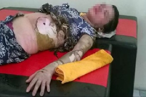 Chị P. (nạn nh&acirc;n của vụ việc chồng thi&ecirc;u sống vợ v&igrave; ghen tu&ocirc;ng v&ocirc; cớ) nhập viện trong t&igrave;nh trạng bỏng nặng