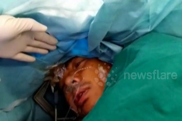 Bệnh nh&acirc;n n&oacute;i chuyện trong khi mổ n&atilde;o l&agrave; chuyện lạ c&oacute; thật tại Trung Quốc