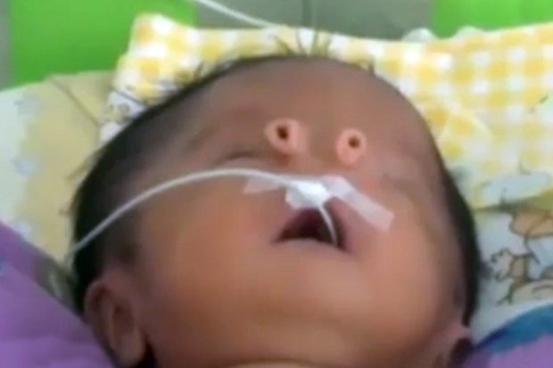 Em b&eacute; sơ sinh c&oacute; hai lỗ mũi như hai chiếc ống nhỏ l&agrave; c&acirc;u chuyện lạ c&oacute; thật ở Peru