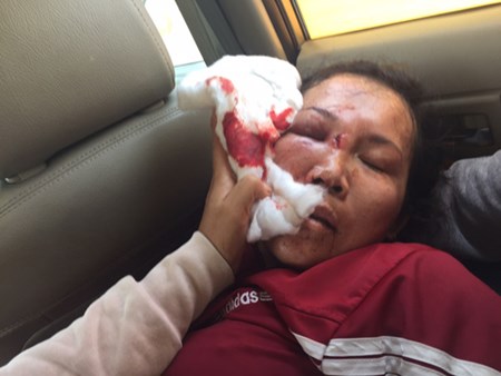 Nạn nh&acirc;n L&ecirc; Thị Trường An bị gia đ&igrave;nh c&ocirc;ng an x&atilde; Nguyễn Thế Phong đ&aacute;nh hội đồng do thiếu nợ tiền ghi đề c&aacute;ch đ&acirc;y 6 năm