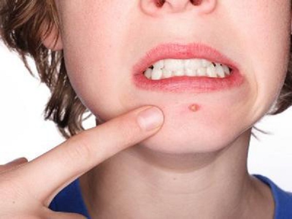 C&oacute; thể sử dụng một số loại thuốc đặc trị để chữa bệnh mụn rộp hiệu quả