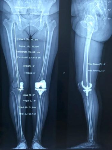 Sản phụ bị tho&aacute;i h&oacute;a khớp v&igrave; giảm c&acirc;n sau sinh