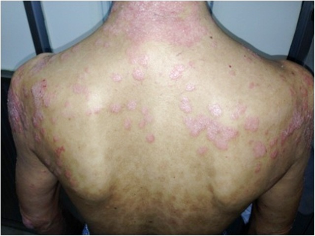 H&igrave;nh ảnh bệnh nh&acirc;n vảy nến điều trị tại BV Da liễu Trung ương. Ảnh: Sức khỏe đời sống