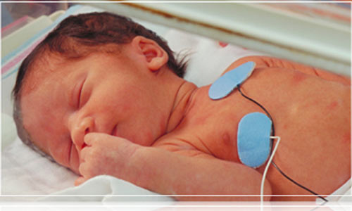 Trẻ sơ sinh bị Đảo gốc động mạch - l&agrave; một dị tật tim bẩm sinh hiếm gặp m&agrave; th&ocirc;ng thường tới 99% sẽ tử vong. ẢNh minh họa  