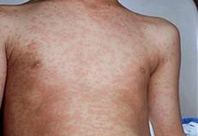 Lũy t&iacute;ch từ đầu năm, to&agrave;n TP H&agrave; Nội ghi nhận 168 trường hợp mắc sốt ph&aacute;t ban dạng sởi v&agrave; 1 trường hợp tử vong. Ảnh minh họa