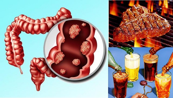 Chế độ ăn uống l&agrave; một trong những nguy&ecirc;n nh&acirc;n g&acirc;y ung thư trực tr&agrave;ng