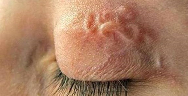 H&igrave;nh ảnh k&yacute; sinh tr&ugrave;ng di chuyển dưới da