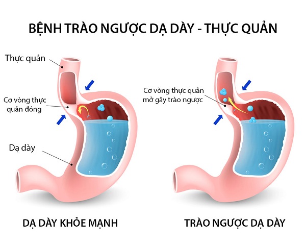  M&ocirc; tả về bệnh tr&agrave;o ngược dạ d&agrave;y