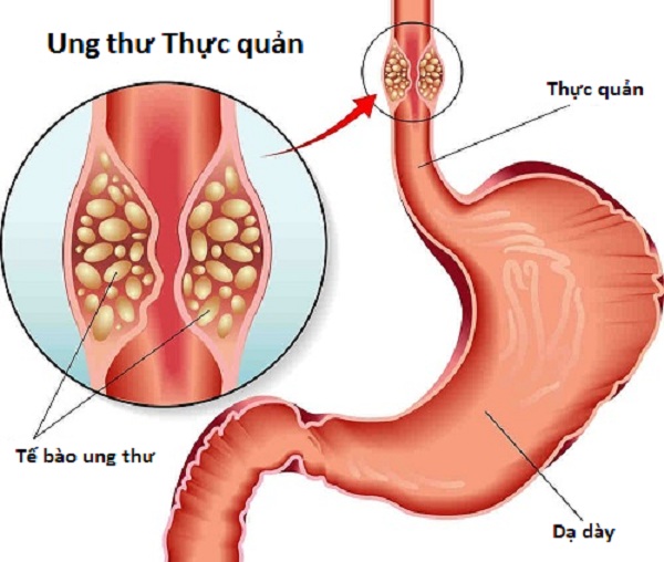 C&aacute;c biểu m&ocirc; bị axit ăn m&ograve;n biến th&agrave;nh m&ocirc; dị sản tiền ung thư
