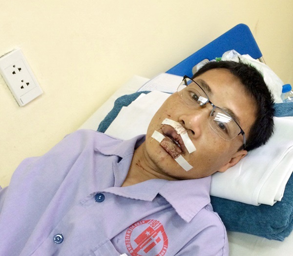 Anh Quang bị chấn thương phần mềm, dập m&ocirc;i v&agrave; kh&acirc;u nhiều mũi 