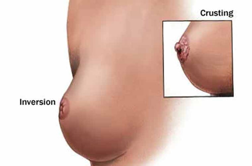 Ung thư v&uacute; : Ph&aacute;t hiện sớm cơ hội sống s&oacute;t cao