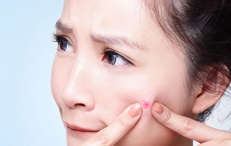 9 nguy&ecirc;n nh&acirc;n g&acirc;y mụn trứng c&aacute; bạn kh&ocirc;ng n&ecirc;n bỏ qua