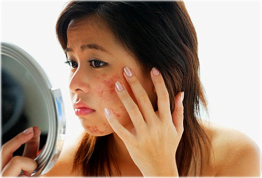 9 nguy&ecirc;n nh&acirc;n g&acirc;y mụn trứng c&aacute; bạn kh&ocirc;ng n&ecirc;n bỏ qua