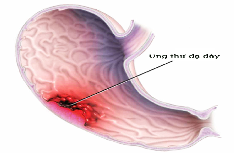 Những thói quen ăn u&ocirc;́ng h&agrave;ng ng&agrave;y g&acirc;y ung thư