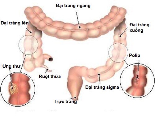 Ung thư đại thực tr&agrave;ng ở những người trẻ ng&agrave;y c&agrave;ng tăng